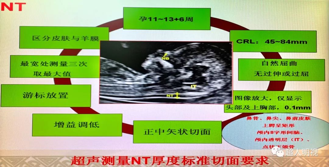 双顶径测量标准切面图片