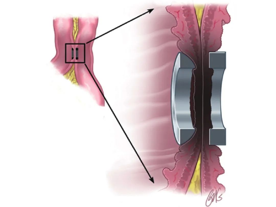 分享磁外科技术在胸外科中的应用进展