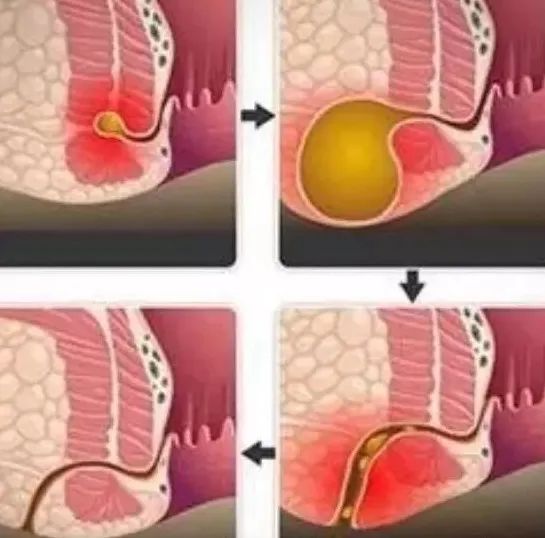 肛周脓肿手术3d演示图片