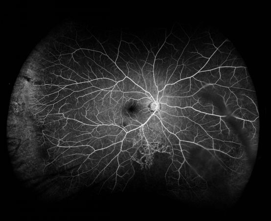 同时,欧堡超广角成像技术,无需散瞳,单次成像轻松获取涡静脉甚至赤道