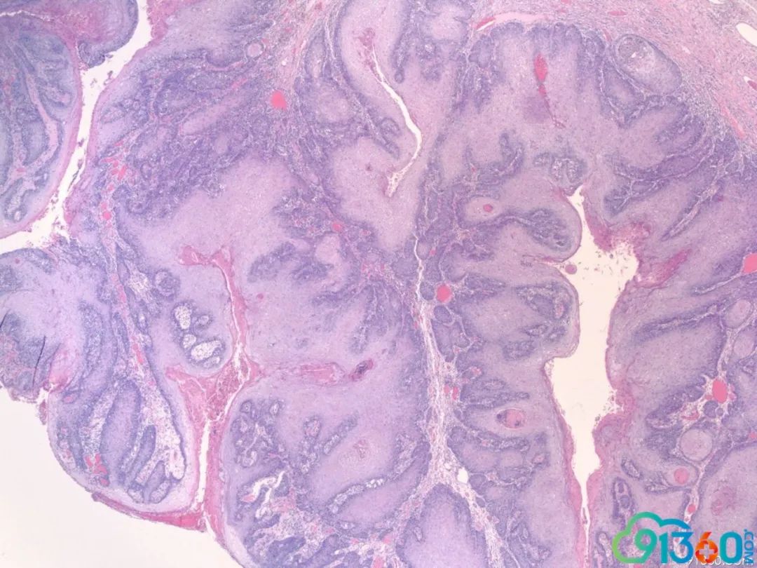 浸润性鳞状细胞癌图片