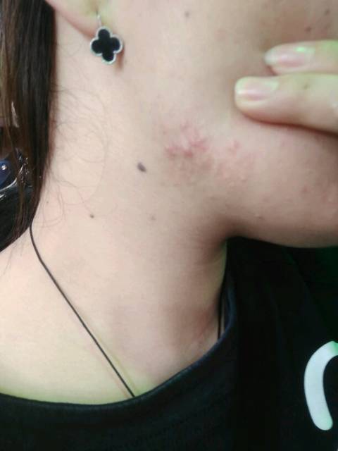 长期戴口罩皮肤差到爆不想痘痘烂一脸大家要这样做