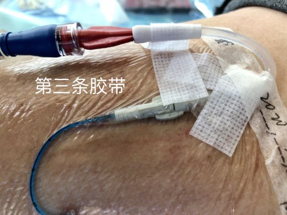 picc维护经常做这些敷贴固定小窍门你知道吗