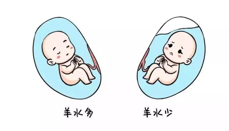 羊水过多=羊水过多最常见的病因是
