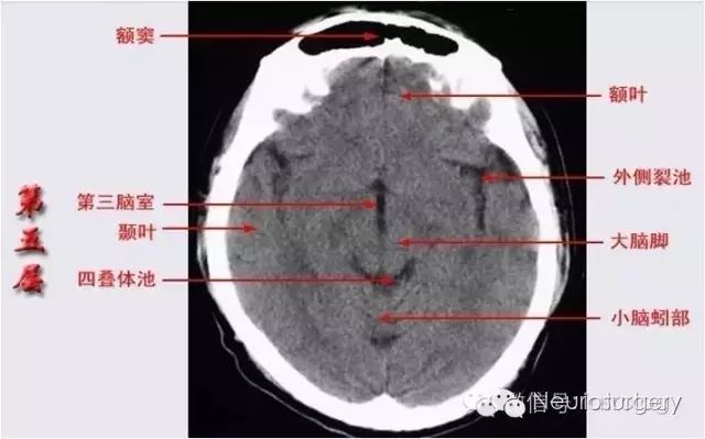 颅脑ct彩色解剖图更有意想不到的学习秘诀