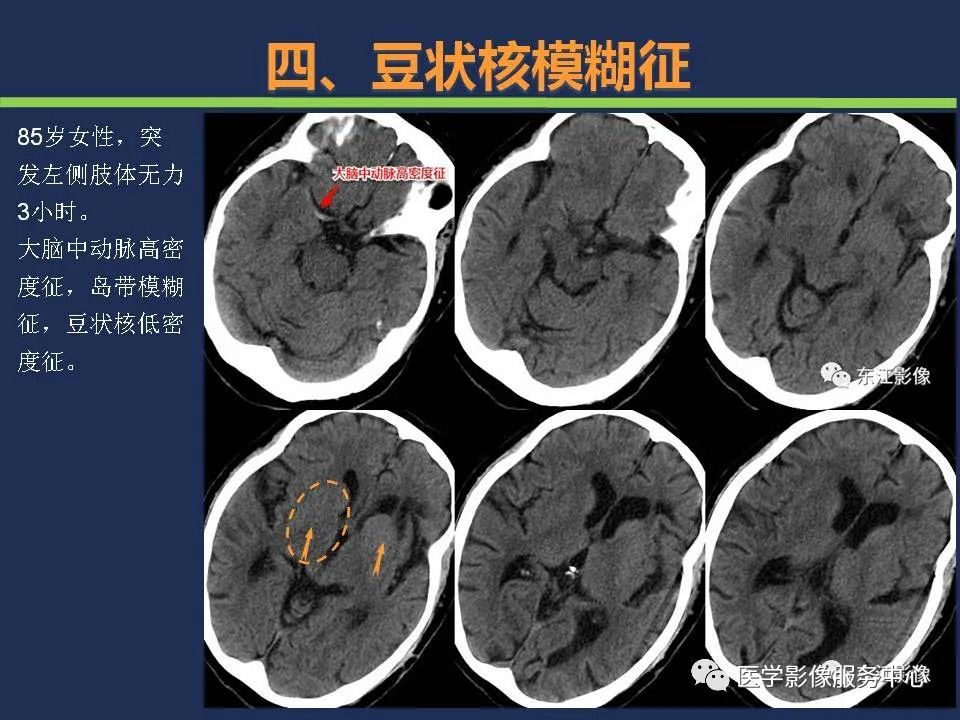 汇总超早期脑梗死ct征象