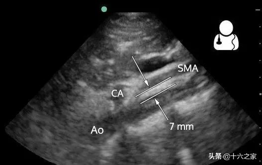 腹部超声慢性腹痛肠系膜上动脉综合征