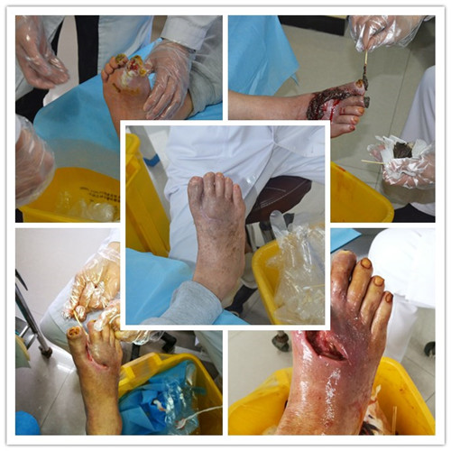 否认"冠心病"史,否认"肝炎,结核,伤寒"等传染病,否认手术史,外伤史及