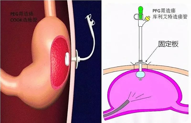 局部麻醉下,用套管针经腹壁穿刺入胃腔置入导丝,引导胃造瘘管进入胃腔