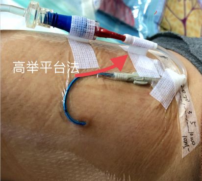 picc维护经常做这些敷贴固定小窍门你知道吗