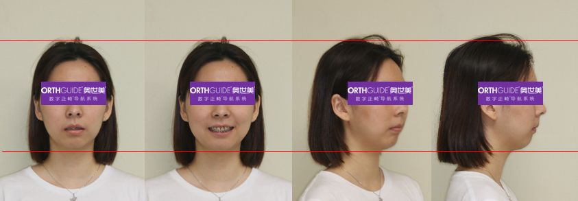 病例分享lorthguide03奥世美03应用于下颌升支吸收