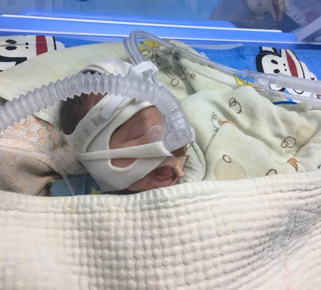 上犹人民医院用无创呼吸机及时挽救早产宝宝