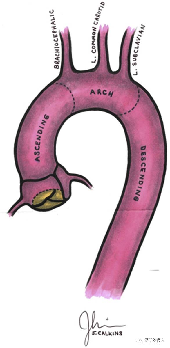 sinotubular junction:窦管交界sinus of valsalva:主动脉窦aortic