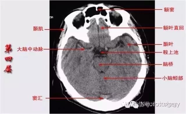 颅脑ct彩色解剖图更有意想不到的学习秘诀