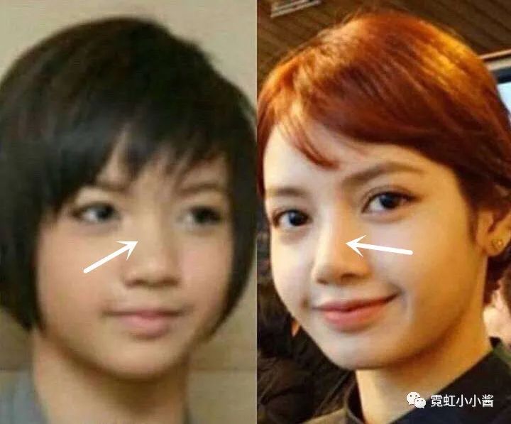 我们在争论lisa整没整容的时候人家已经是最大赢家了日本医美