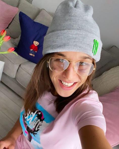 肿块消失,双颊仍有瘀伤_乔安娜