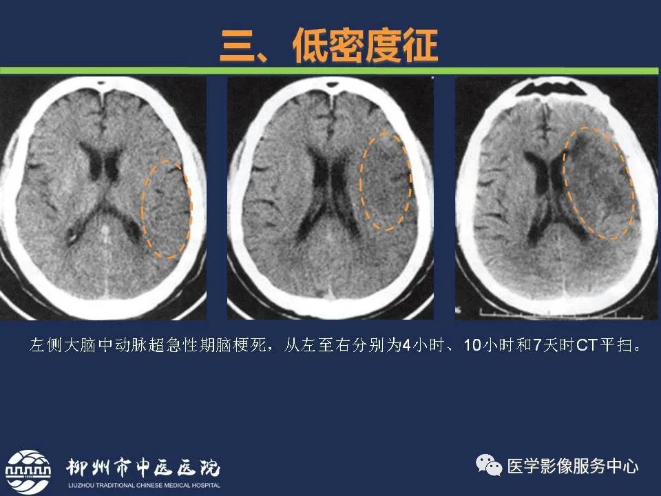 汇总超早期脑梗死ct征象