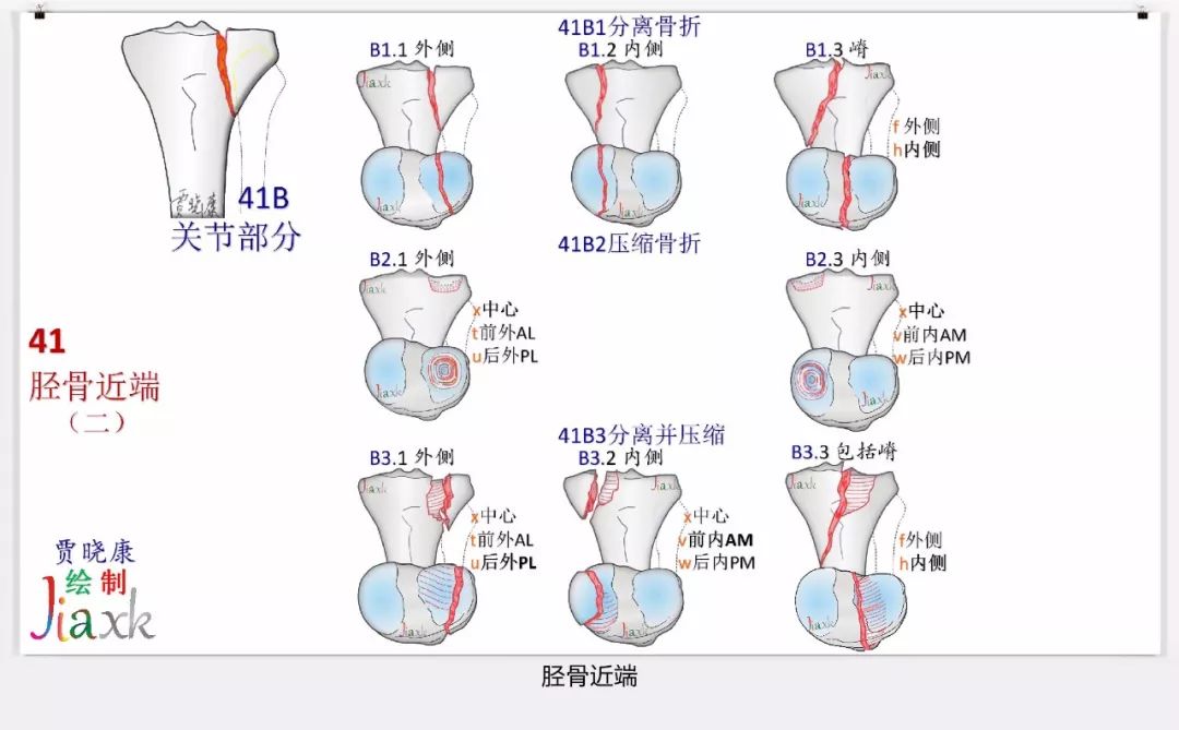 骨外固定相关知识巩固636张ao骨折分型高清实用图谱