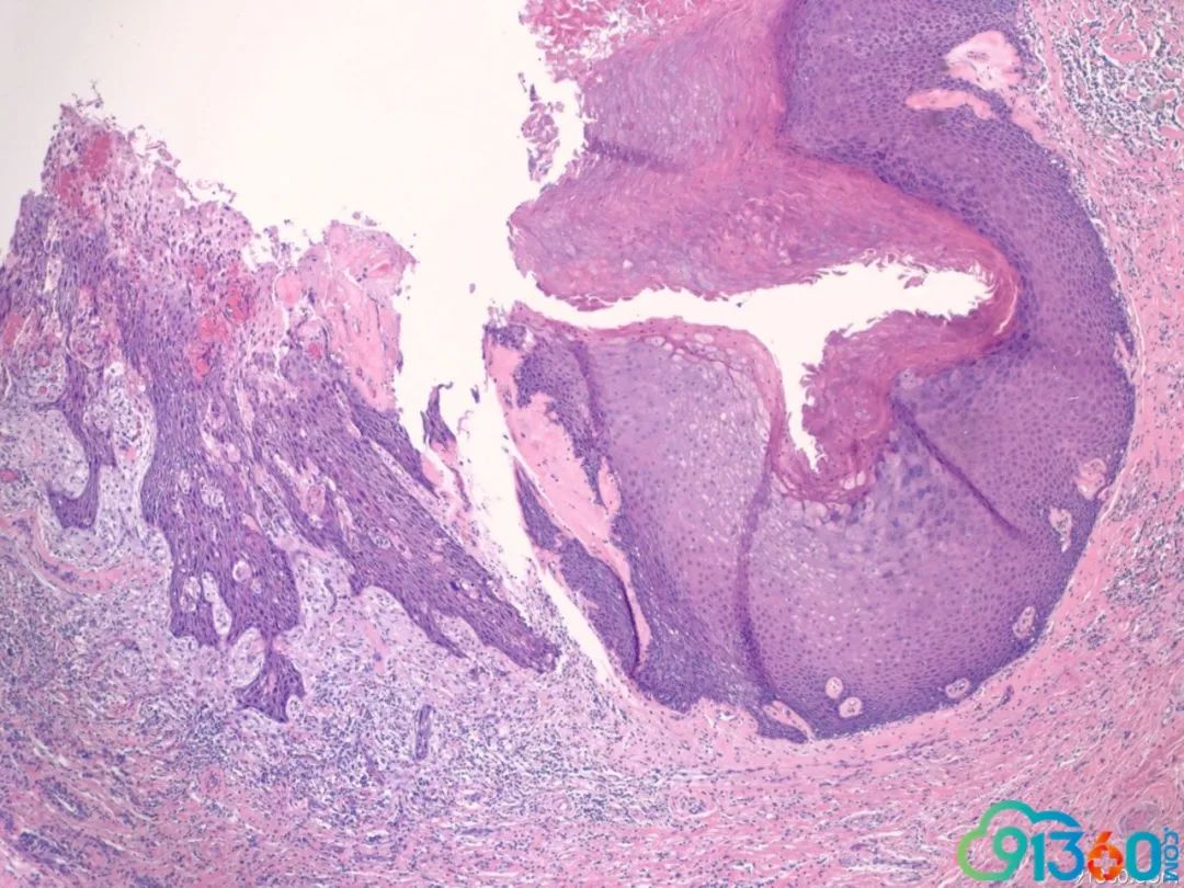 浸润性鳞状细胞癌图片