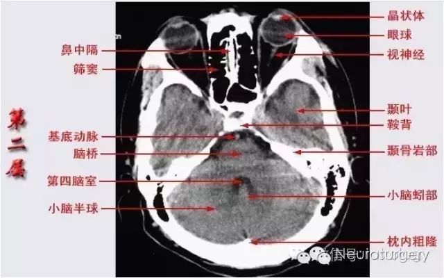 灰质层面( 80mm)8.半卵圆中心层面( 70mm)7.侧脑室顶部层面( 60mm)6.