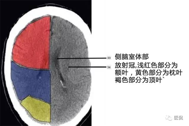 顱腦ct彩色解剖圖更有意想不到的學習秘訣