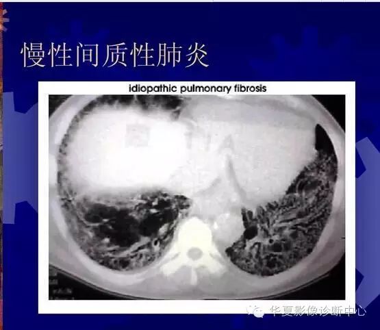 大葉性小葉性間質性肺炎你分清了嗎