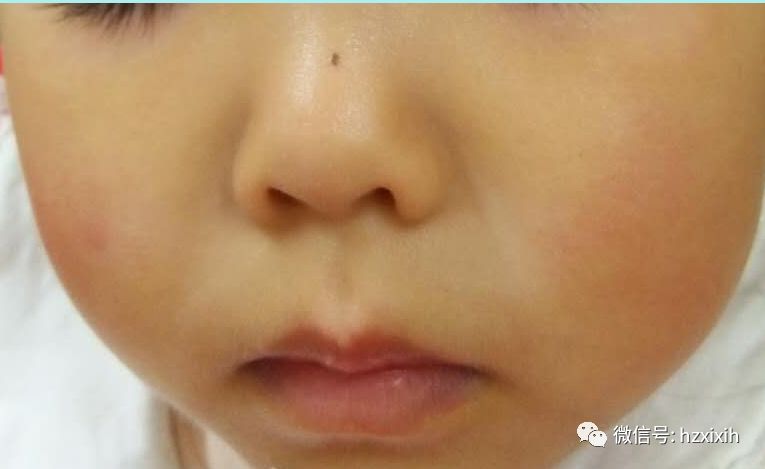 宝宝虫斑脸部图片图片