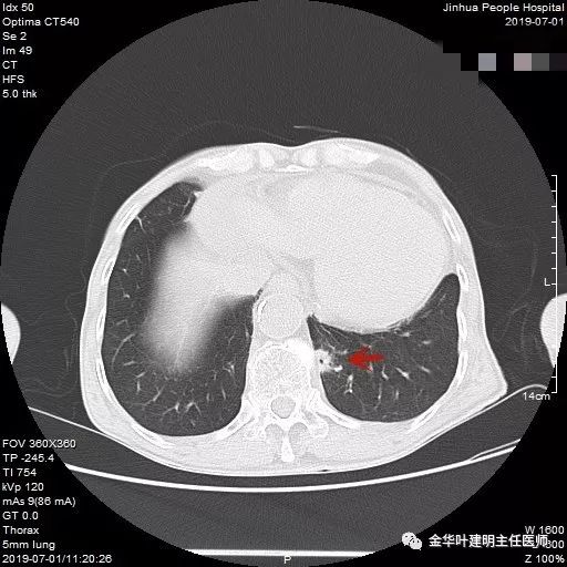 第13例: 左肺下葉混合磨玻璃結節,病灶的瘤肺邊界是相對清楚的,需疑