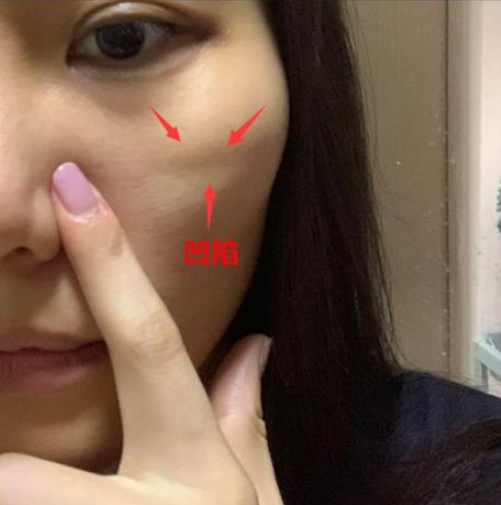 线雕凹陷多久恢复_皮肤