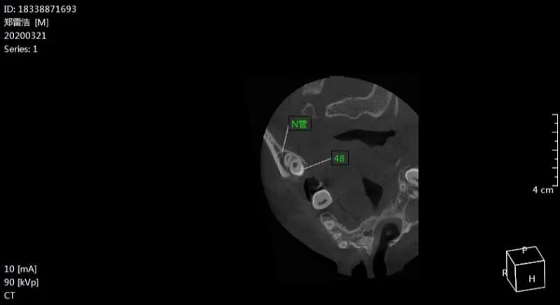 详情ct示:38 近中水平阻生 近中根穿通下颌神经管上壁 远中根根尖1/3