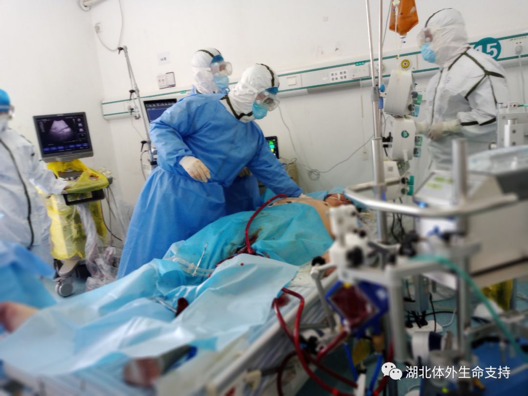 经验新冠肺炎患者的ecmo救治经历