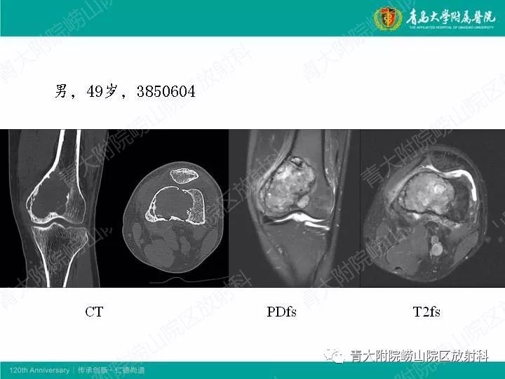 病例讨论尤文肉瘤ewingsarcoma