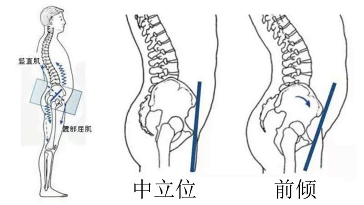 很多人覺得自己是肚子大,尤其女孩子,但其實是骨盆前傾!