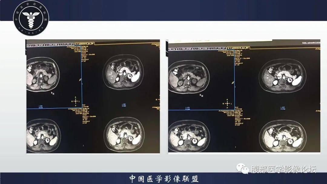 腎臟丨左腎透明細胞癌