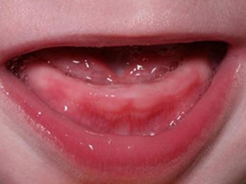 婴儿长牙牙龈变化过程图片
