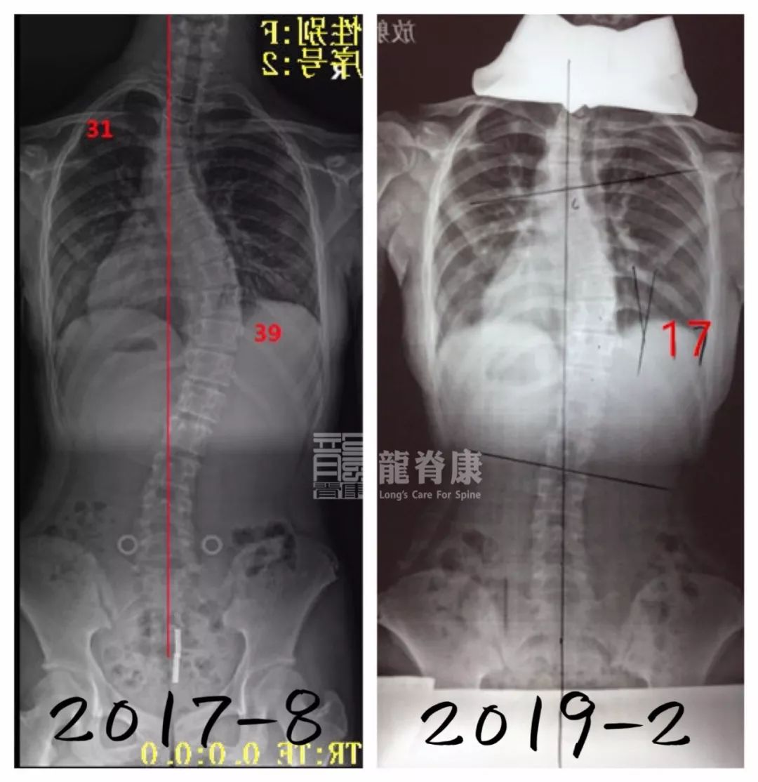 脊柱侧弯剃刀背图片