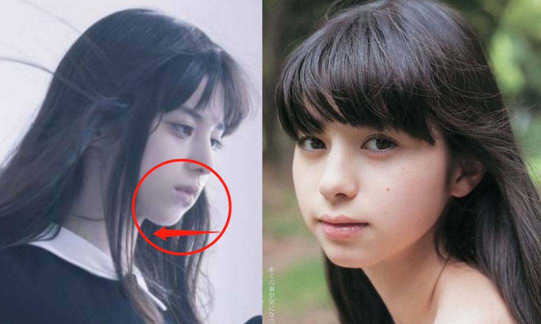 同时颌面瑕疵导致的下巴后缩,凸嘴等问题,视觉上也会加剧面型"短宽"的