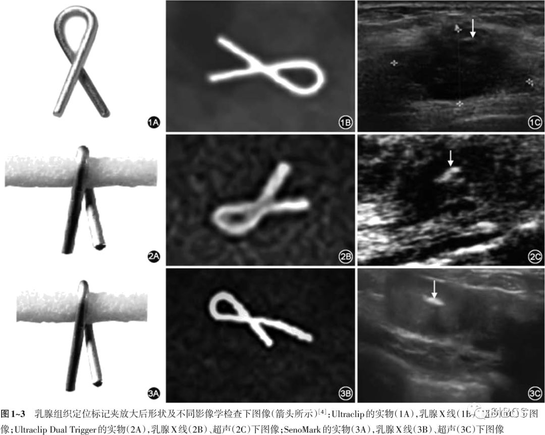 乳腺组织定位标记夹临床应用专家共识
