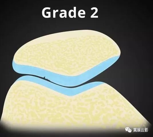 ii級:軟骨變薄出現中度纖維化,表面缺損 全層50%iii級:軟骨重度纖維化