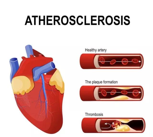 营养与动脉粥样硬化性心脏病