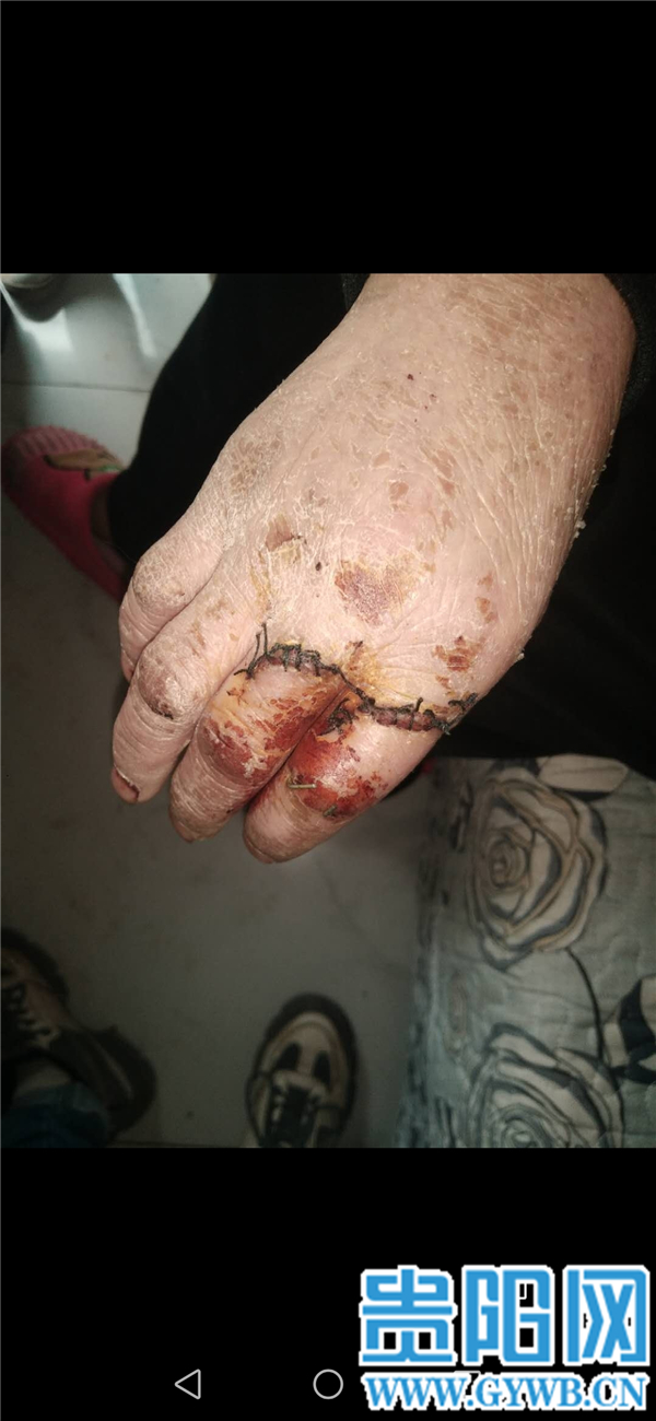 被丈夫砍伤双手贵州一女子手掌离断幸医生抢救保全4手指