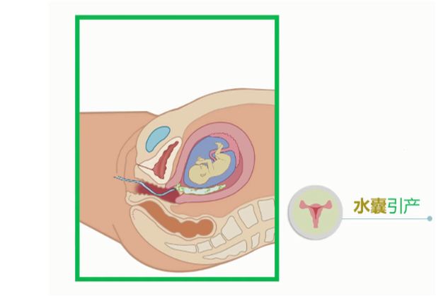 怀孕上水囊图片图片