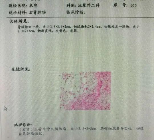 脂肪瘤病理报告图片