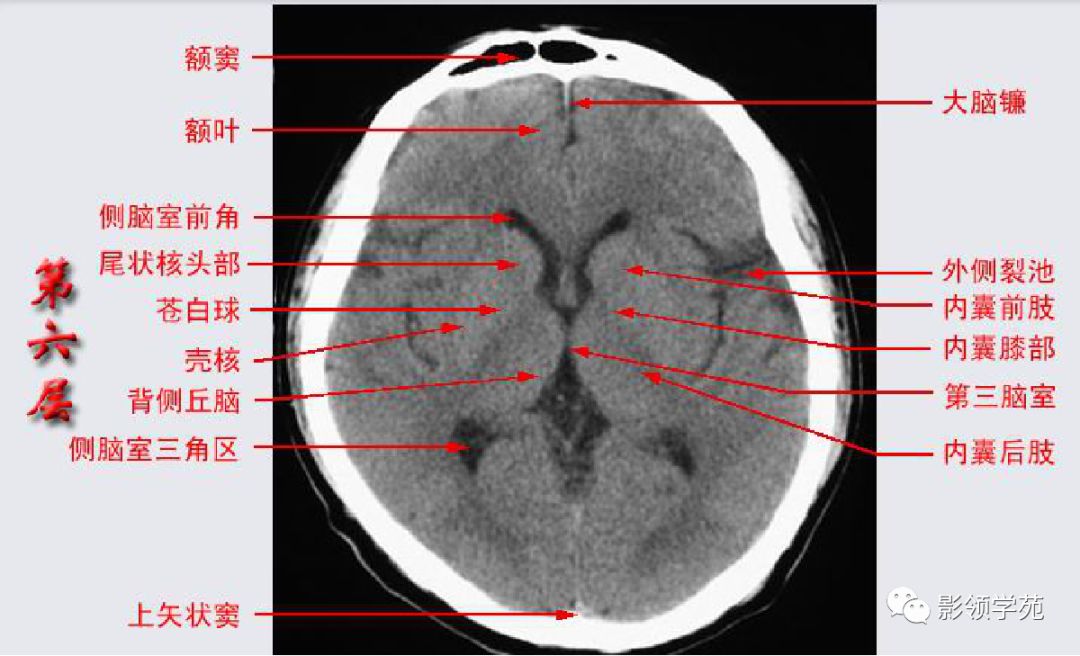 头颅ct基底节区解剖图图片
