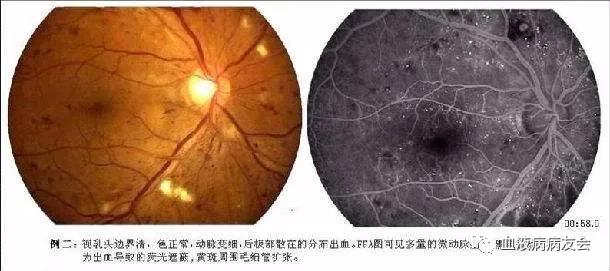 视网膜水肿由于白血病细胞侵犯视神经的不同部位,如果浸润筛板前会让