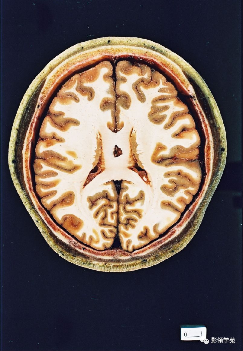 头部ct影像解剖_basal