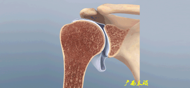 较为准确的命名应该是"冻结肩"或"粘连性关节囊炎",对医生而言,临床上