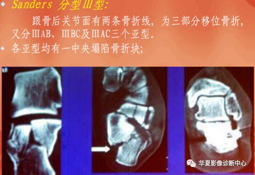 【影像基础】跟骨骨折影像学分型_移位