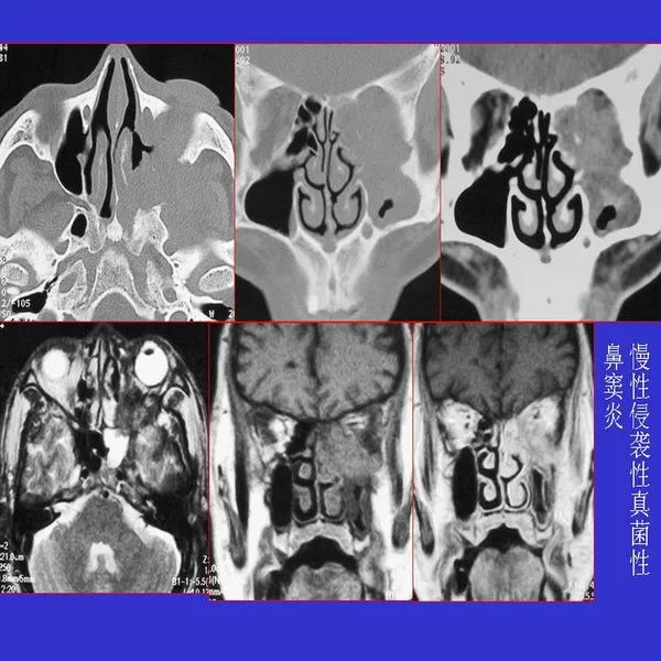 真菌性鼻窦炎影像学诊断