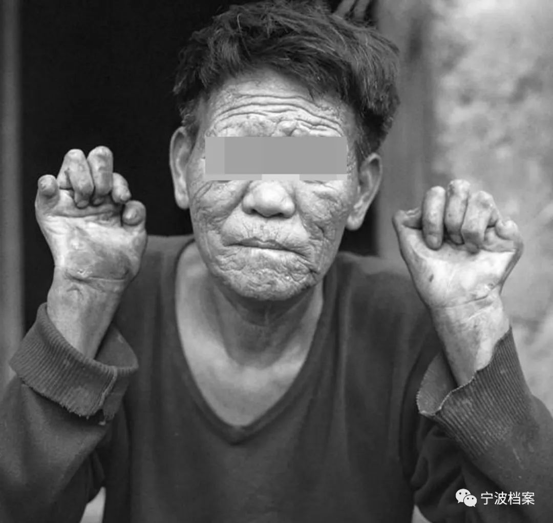 宁波历史上的传染病地方病君知几何